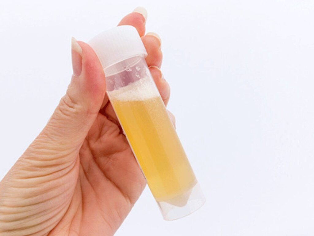 Foamy Urine