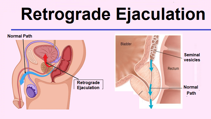 What Are The Causes Of Foamy Urine In Men 