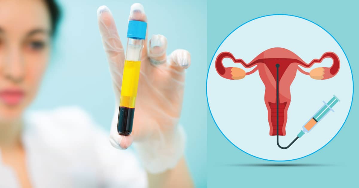 WHAT IS PRP THERAPY? and Recurrent Implantation Failure